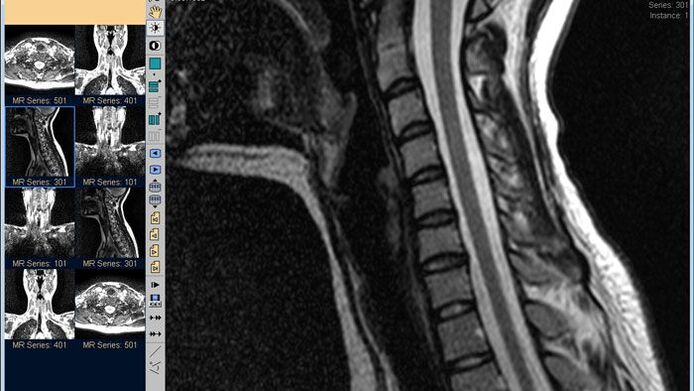 Trápaga bizkarrezurreko MRI lepoko mina diagnostikatzeko metodorik onena da